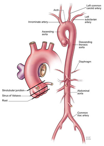 Thoracic Aortic Aneurysm - Mr. Kulvinder Lal