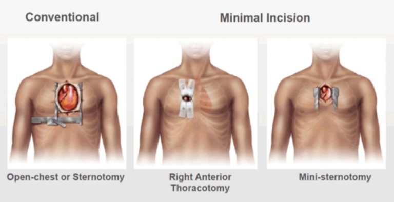 Keyhole Aortic Valve Surgery Mr Kulvinder Lal